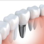 Implanty stomatologiczne – wady i zalety